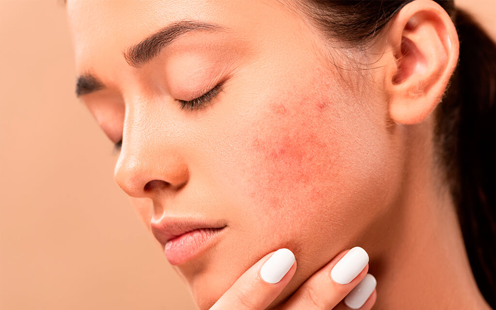 Prisão de ventre e acne. Qual a relação?